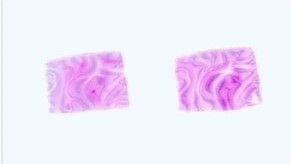 Paraffin Tissue Section - Human Adult Normal: Heart: Pulmonary Valve